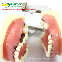 Modelo de enfermedades periodontales adultas f / Tratamiento de enfermedades periodontales 12610